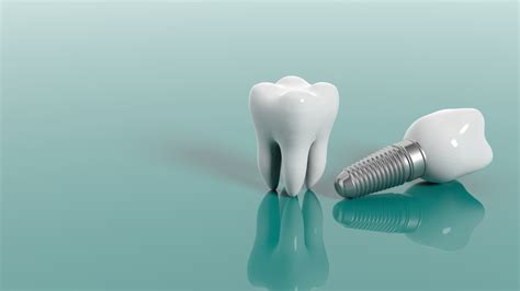 dental implants  nart dental clinic barcelona