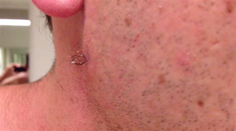 man pulls out the longest ingrown hair in the history of