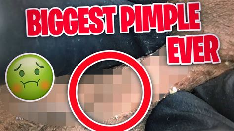 20 of the biggest pimples ever popped on dr pimple popper 🤢 youtube