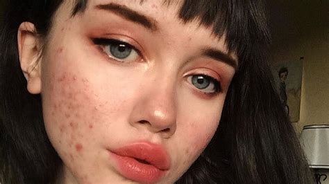 blogger with acne shares makeup free selfies and messages of support