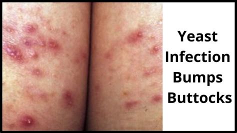 yeast infection bumps causes symptoms treatment and cure