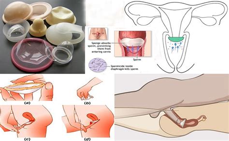 know more about different contraception methodsann news