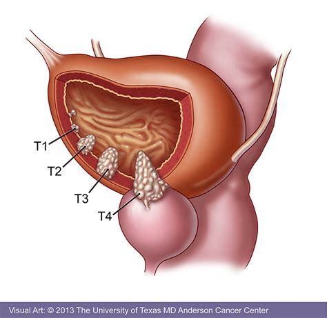 bladder cancer tumor removal