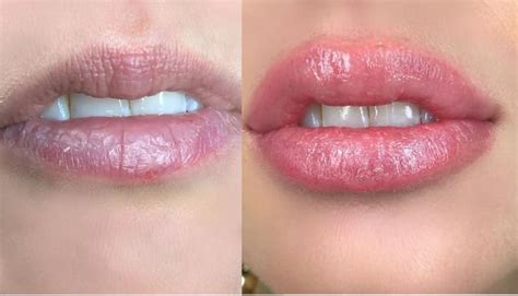 Gloss And Go Lips Before After