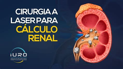 como  feita  cirurgia de pedra nos rins ictedu