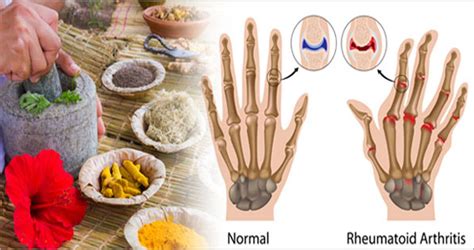 9 herbal remedies for treating rheumatoid arthritis health gadgetsng