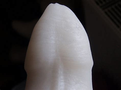 vaginal stretch marks