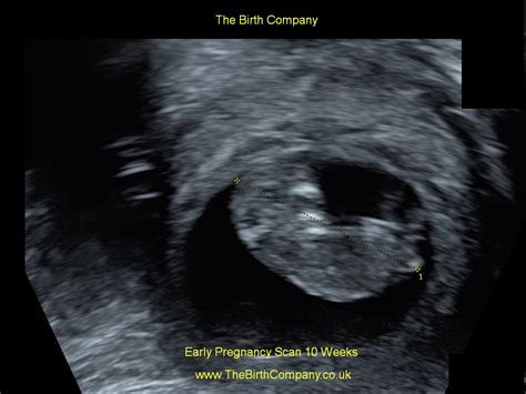 Early Pregnancy Scan £125 Viability Scan In London The Birth Company