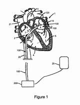 Patents Catheter Ablation sketch template