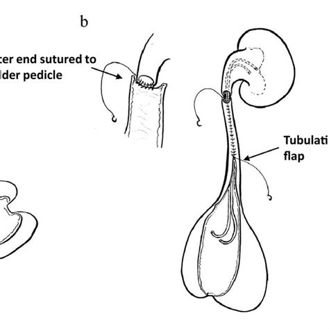 Schematic Diagram Of The Surgery A Bladder Flap Taking B Ureter