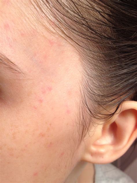 allergic reaction  makeup  face mugeek vidalondon