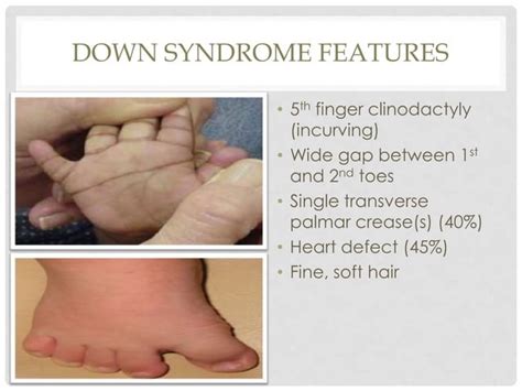 Pervasive Developmental Disorders Turner Syndrome Klinefelters