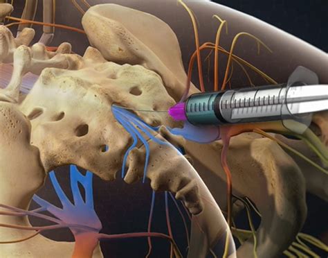 caudal epidural steroid injection treatments twin cities pain clinic