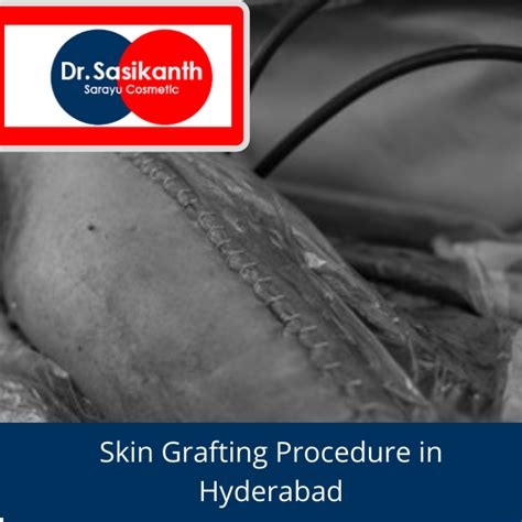 skin grafting  procedure    skin grafting