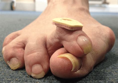 hallux valgus bunion conditions  london foot ankle clinic