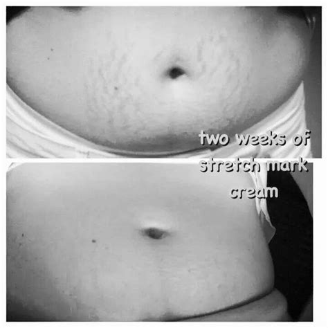 Wow Look At These Amazing Results Just 2 Weeks On It Works Stretch Mark