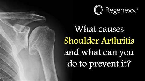 What Causes Shoulder Arthritis Regenexx®