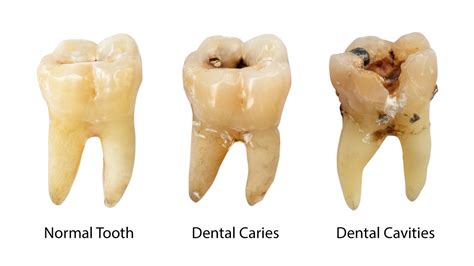 cavity  enclave dental preetha thomas dds enclave dental preetha