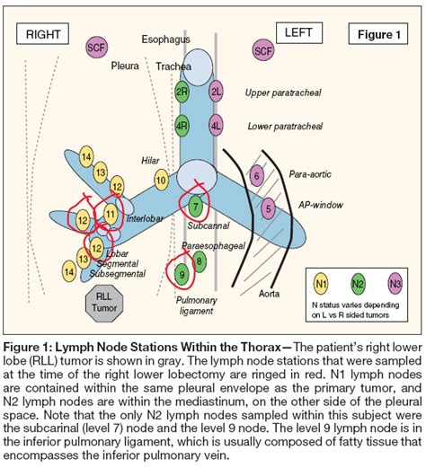 Unexpected N2 Lymph Node Involvement Found During Surgery