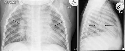 Tuberculous Mediastinal And Hilar Lymphadenopathy In A 2 Year Old Male