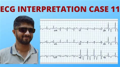 Ecg Interpretation Case 11 Ekg Electrocardiogram Youtube