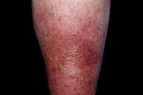 signs symptoms cellulitis  skin infection   legs feet