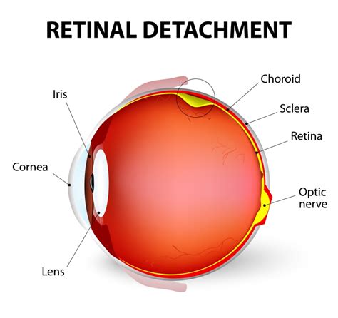 symptoms  retinal detachment retina macula specialists
