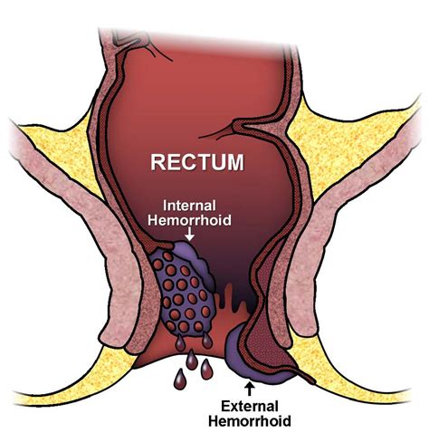 hemorrhoids ascrs