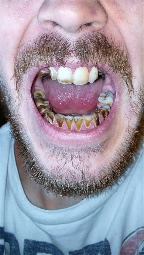 start severely messed  teeth advice dentistry