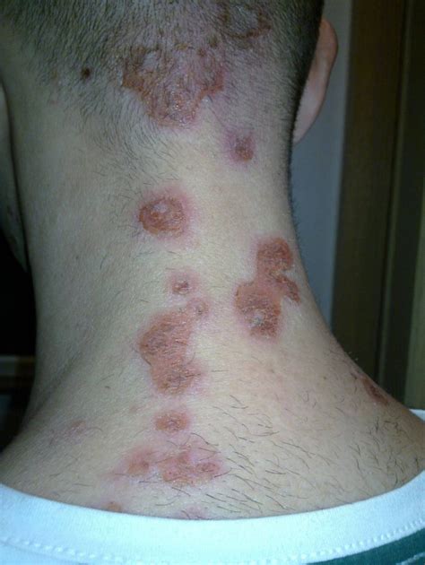 What Do Bed Bug Bites Look Like 7 Bite Symptoms With