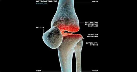 osteoarthritis symptoms  types risk  treatments