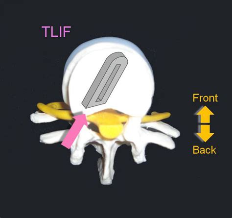 Tlif Transforaminal Lumbar Interbody Fusion Texas Minimally