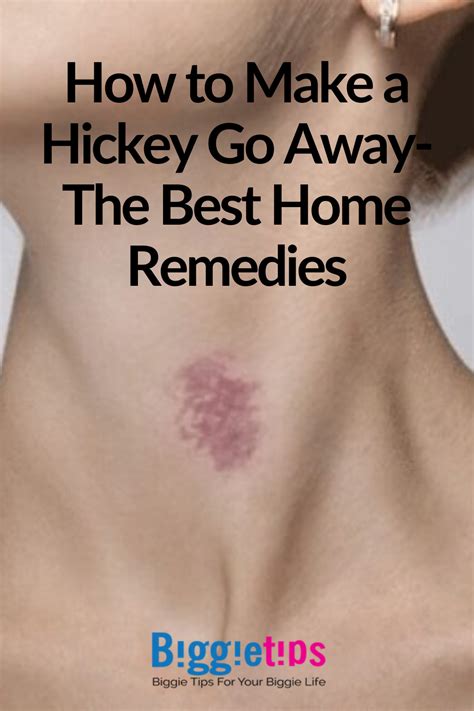 how to make a hickey go away the best home remedies