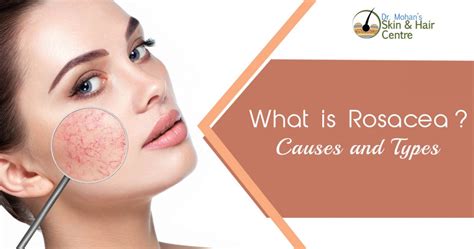 Rosacea Causes And Types