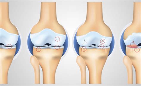 Fda Approves Expanded Efficacy Of Knee Osteoarthritis Pain Treatment
