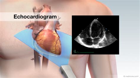 ultrasound   heart