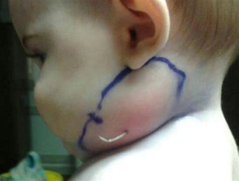 تصاویر درآمدن پر از گردن نوزاد 6 ماهه