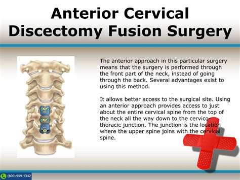 Ppt Anterior Cervical Discectomy Fusion Spine Tech