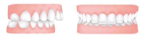 What’s The Difference Between An Overbite And An Overjet Central