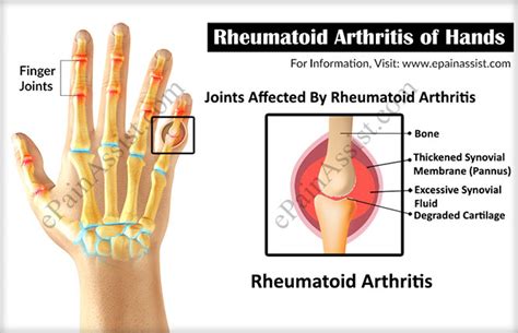 rheumatoid arthritis of hands symptoms signs treatment conservative pt