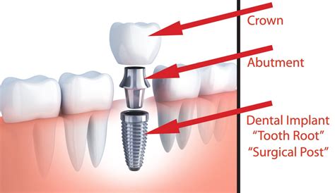 dental implant surgery art  smiles