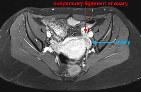 suspensory ligaments   female genital organs mri evaluation  intraoperative
