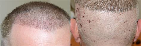 Hair Transplants For Men Pictures Miami Fl Paciente 58703