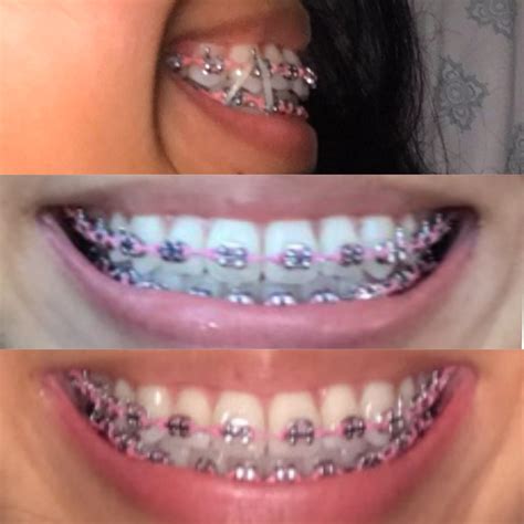 teeth  flared rbraces