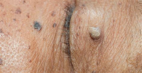 when to consider skin tag removal orlando fl dr