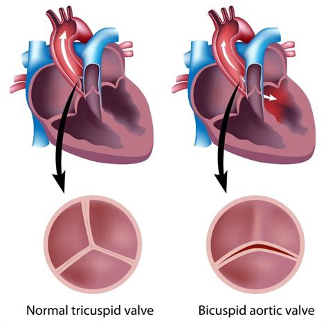 Bicuspid Aortic Valve Cardiology Highland Hospital University Of