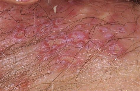 120 best images about genital herpes on pinterest