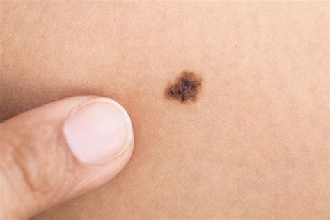 Melanoma Facts 6 Things To Know