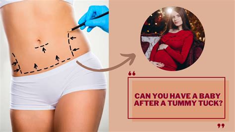 baby   tummy tuck answered