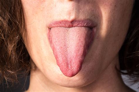 burning tongue    life threatening scary symptoms